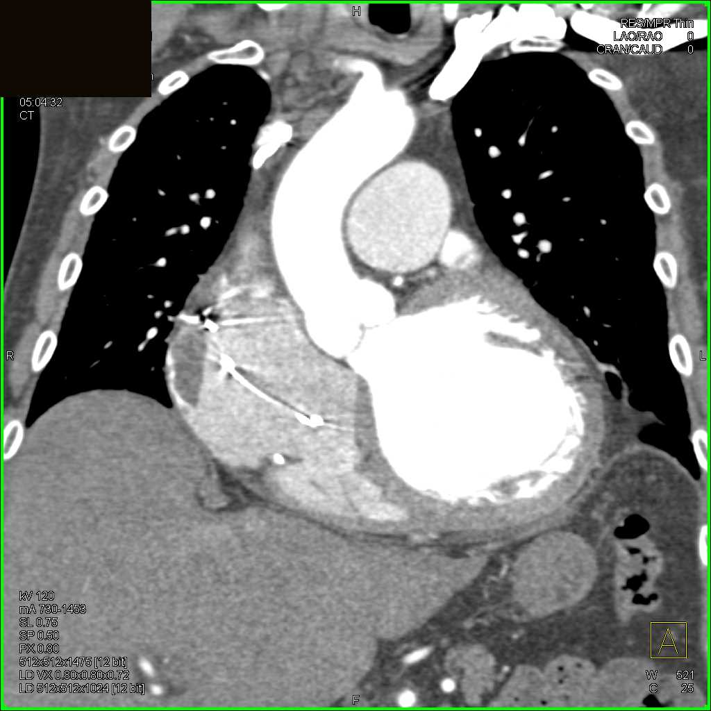 Clot in Right Atrium - CTisus CT Scan