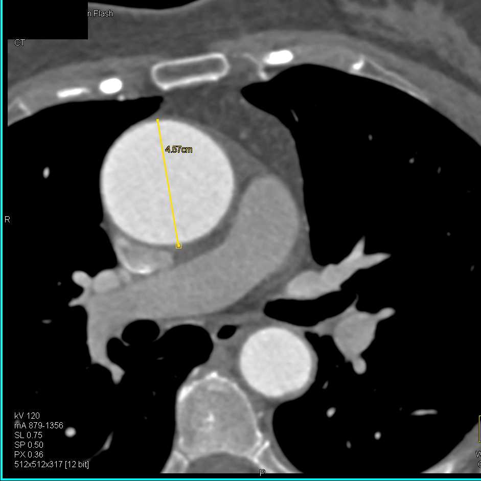 Bicuspid Aortic Valve and Dilated Ascending Aorta - CTisus CT Scan