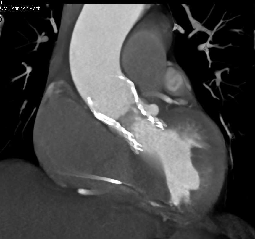 Post Transcatheter Aortic Valve Replacement (TAVR) with Clot on Aortic Valve - CTisus CT Scan