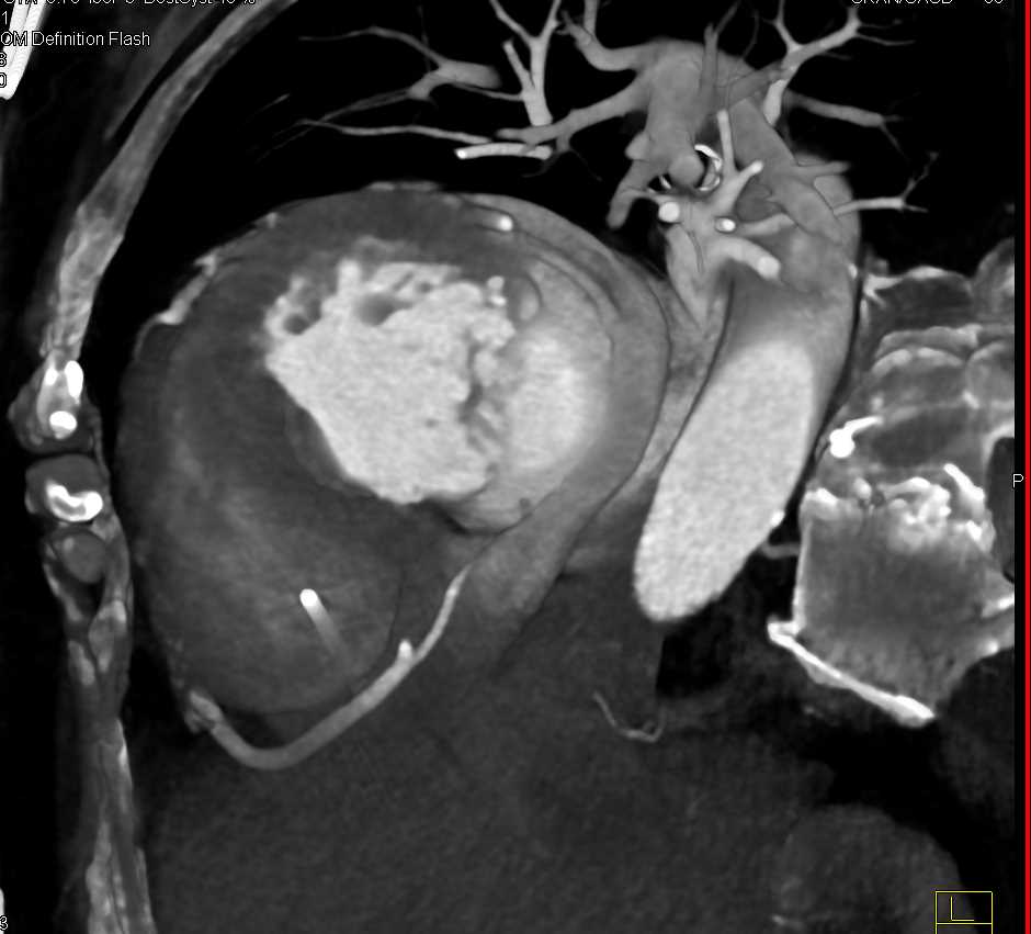 Post TAVR with Clot on Aortic Valve - CTisus CT Scan