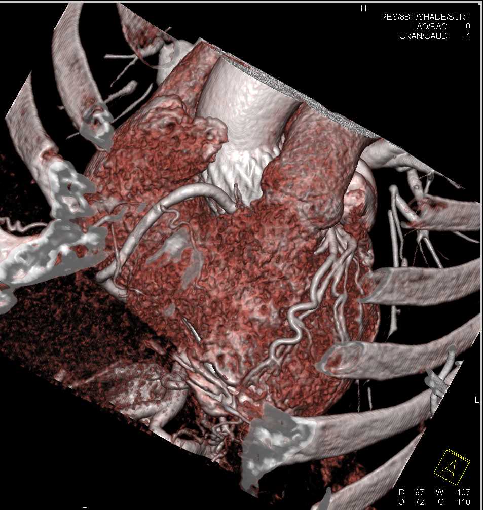 Post TAVR Changes Aortic Valve - CTisus CT Scan