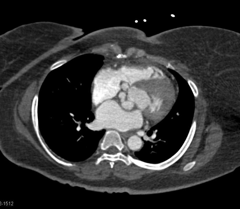 AVR with Dilated Coronary Arteries - CTisus CT Scan