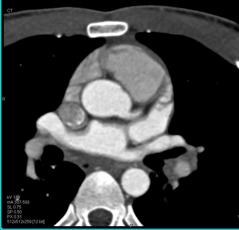 Kawasakis Disease Involves the LAD - CTisus CT Scan