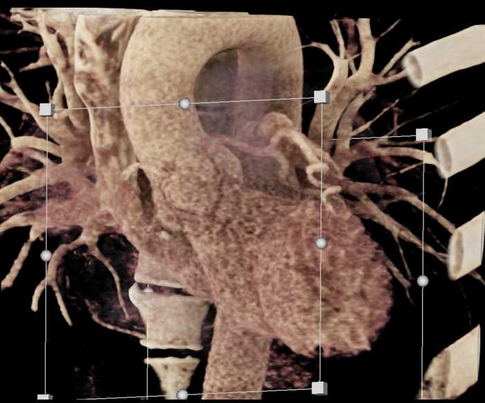 Coronary Artery Mapping - CTisus CT Scan