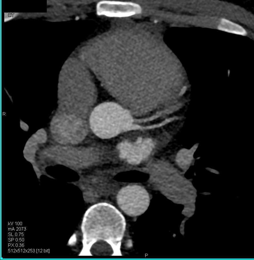 Two Left Coronary Arteries off the Left Cusp - CTisus CT Scan