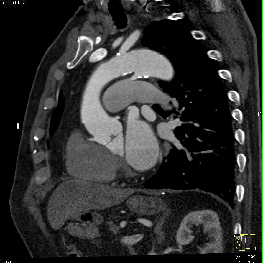 Patent Patent Ductus Arteriosus (PDA) - CTisus CT Scan
