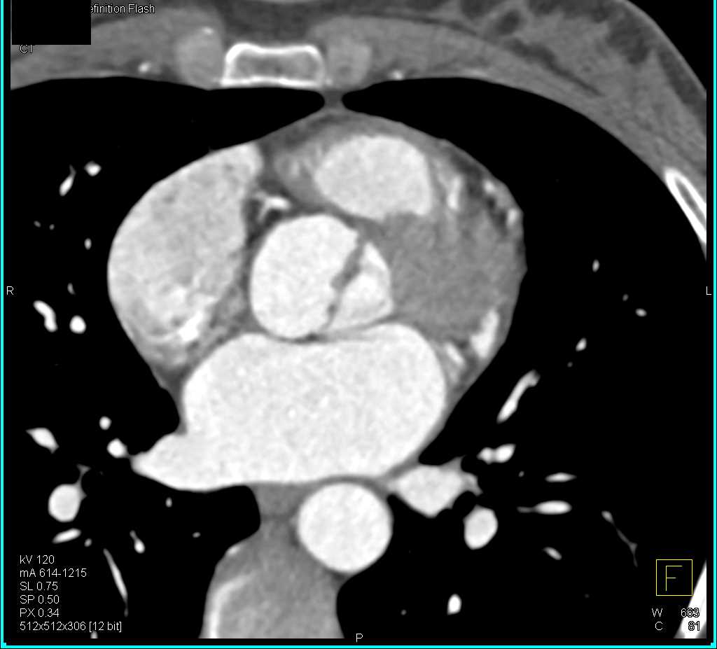 Bicuspid Aortic Valve - CTisus CT Scan