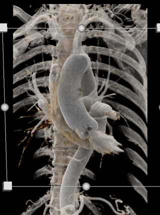 Bicuspid Aortic Valve with Calcifications - CTisus CT Scan