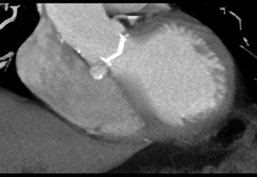Aortic Valve Replacement - CTisus CT Scan