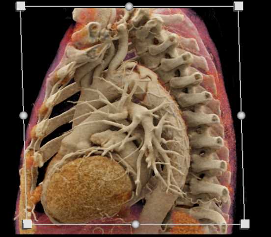 Endovascular Stent Repair with Cinematic Rendering (CR) Display - CTisus CT Scan