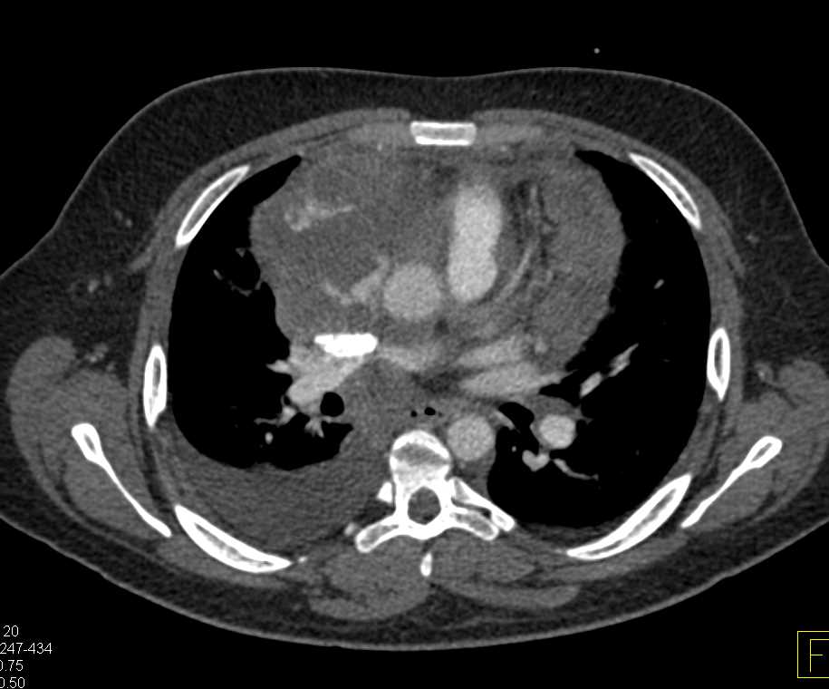 Cardiac Angiosarcoma - CTisus CT Scan