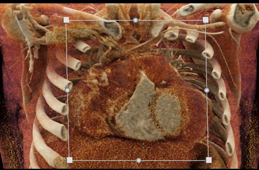 Cardiac Angiosarcoma - CTisus CT Scan