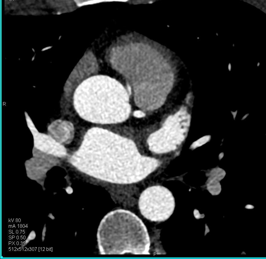 RCA Arises off Left Coronary Artery in Malignant Configuration - CTisus CT Scan