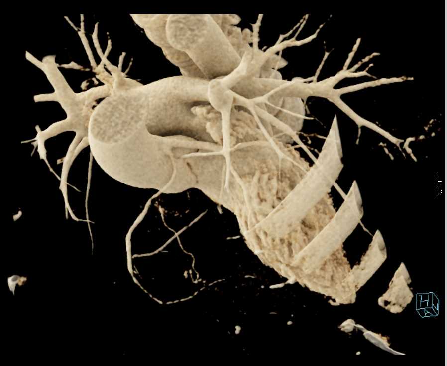 RCA Arises off Left Coronary Artery in Malignant Configuration - CTisus CT Scan
