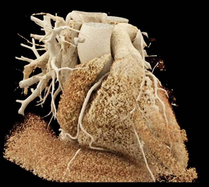 RCA Arises off Left Coronary Artery in Malignant Configuration - CTisus CT Scan