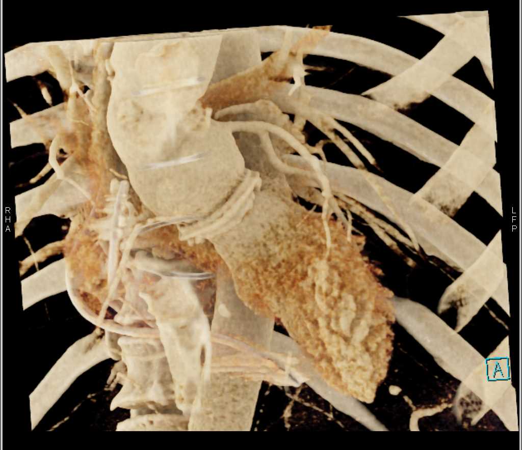 Vegetation on Aortic Valve with Cinematic Rendering - CTisus CT Scan