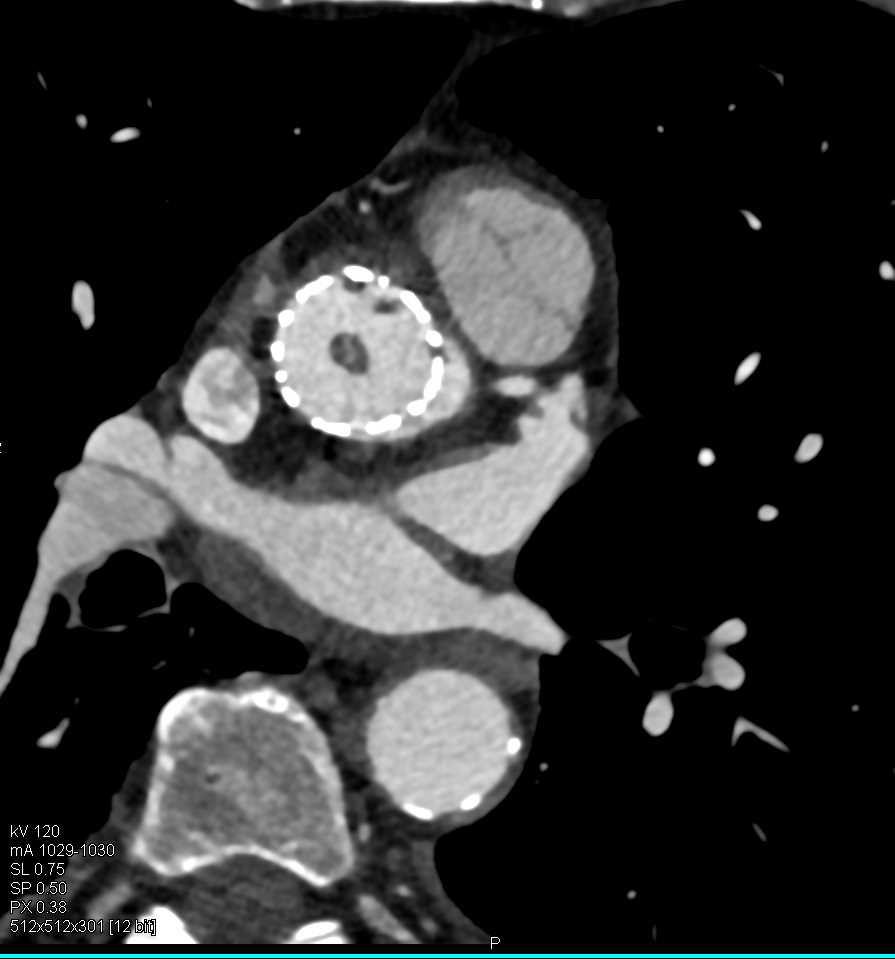 Vegetation on Aortic Valve - CTisus CT Scan