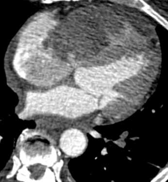 Intracardiac Spindle Cell Tumor - CTisus CT Scan