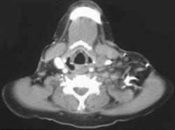 Innominate and Jugular Vein Thrombosis - CTisus CT Scan