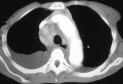 Castleman Disease - CTisus CT Scan