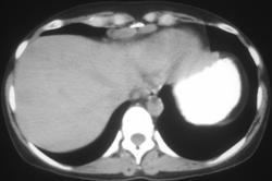 Lymphoma With Paracardiac Nodes - CTisus CT Scan