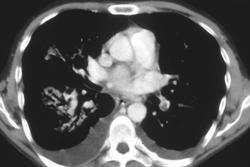 Pulmonary Embolism - CTisus CT Scan