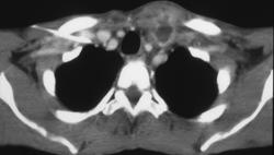 Neck Abscess Extends Into the Mediastinum - CTisus CT Scan