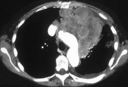 Lymphoma - CTisus CT Scan