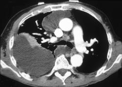 Loculated Effusions Simulate A Mediastinal Mass - CTisus CT Scan