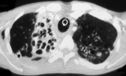 Cystic Fibrosis - CTisus CT Scan