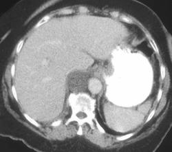 Lymphocele - CTisus CT Scan