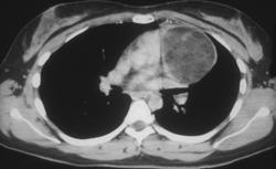 Germ Cell Tumor - CTisus CT Scan