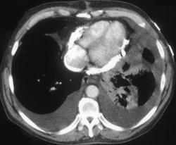 Calcified Pericardium - CTisus CT Scan