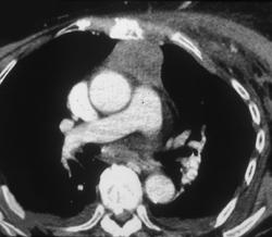 Breast Cancer With Anterior Mediastinal Nodes - CTisus CT Scan