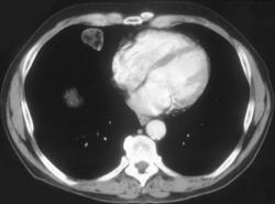 Hamartoma - CTisus CT Scan