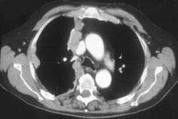 Mesothelioma - CTisus CT Scan