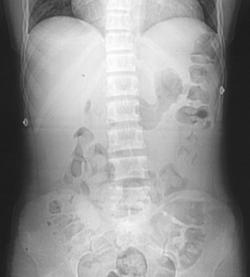 Calcified Myocardium Due to Renal Failure - CTisus CT Scan