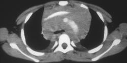 Lymphoma - CTisus CT Scan