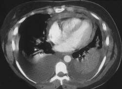 Pericardial Effusion With Poor Cardiac Function - CTisus CT Scan