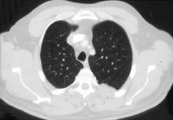 Small Cell Cancer Metastases to Chest Wall - CTisus CT Scan