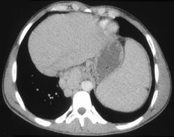 Esophageal Varices Simulated A Posterior Mediastinal Mass - CTisus CT Scan