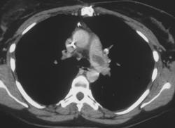 Pulmonary Embolism - CTisus CT Scan