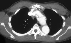 Type B Dissection - CTisus CT Scan