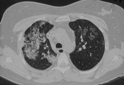 Cytomegalovirus (CMV) Infection - Chest Case Studies - CTisus CT Scanning