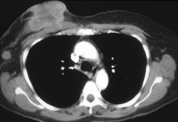 Ulcerating Breast Cancer - CTisus CT Scan