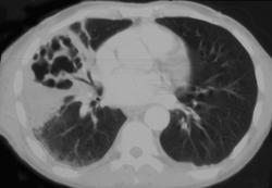 Lung Abscess - CTisus CT Scan