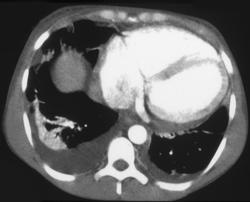 Heart Failure and Large IVC - CTisus CT Scan