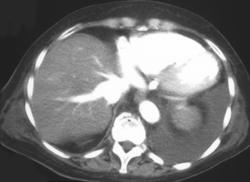 Poor Cardiac Function - CTisus CT Scan