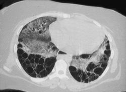 Pulmonary Edema - CTisus CT Scan