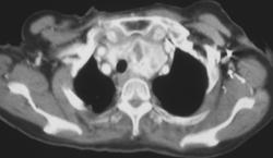 Substernal Thyroid (middle Mediastinum) - CTisus CT Scan